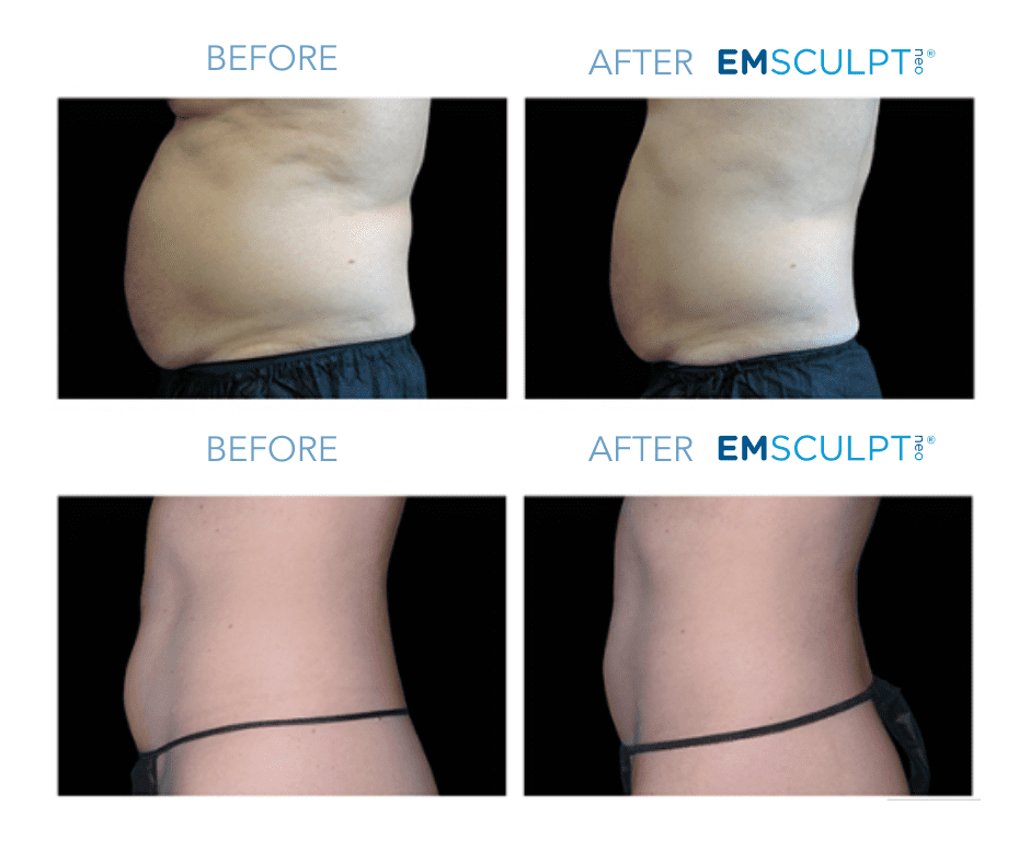 Non-invasive body sculpting treatment